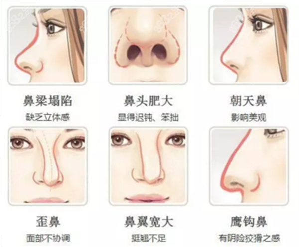 隆鼻