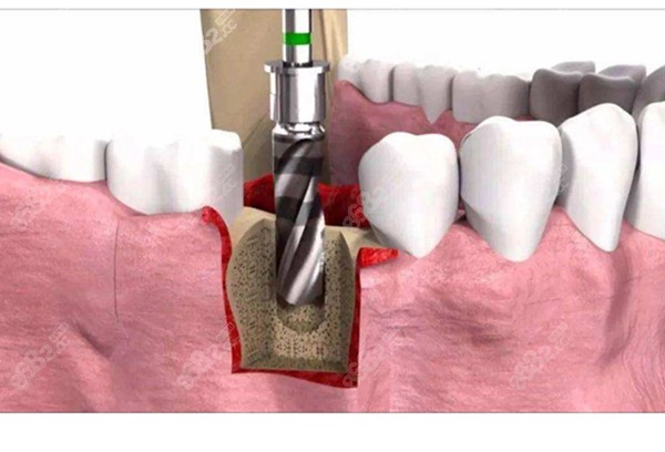 种植牙的植入过程www.8682.cc