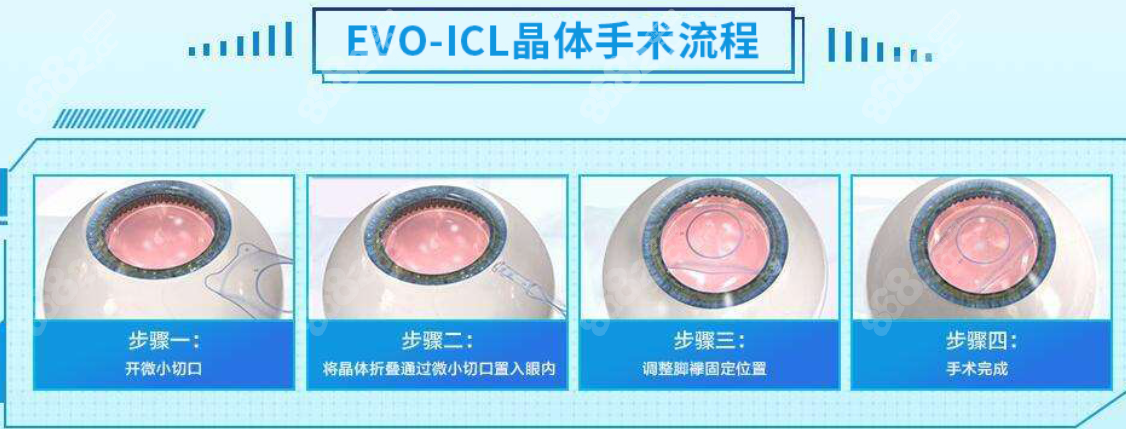 眼睛虹膜炎症、青光眼、糖尿病人不适合icl晶体植入