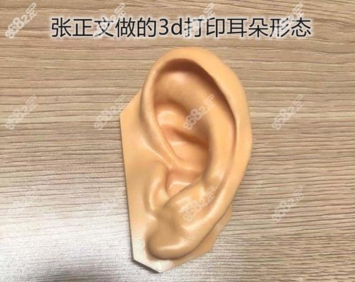 3d打印耳朵再造术过程分享