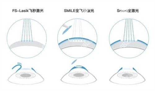 爱尔眼科医院近视眼手术价格是多少？