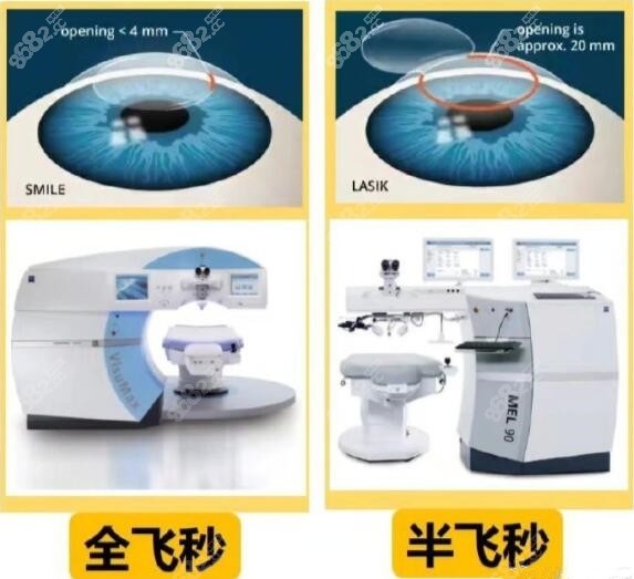 半飞秒激光矫正近视手术价格多少钱m.8682.cc