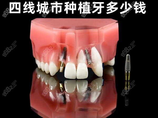 四线城市种植牙多少钱