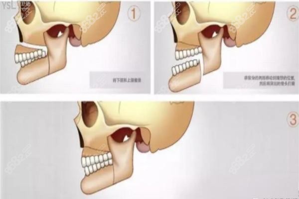 正颌手术步骤