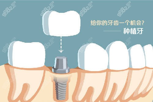 厦门种植牙口腔医院排名和收费标准