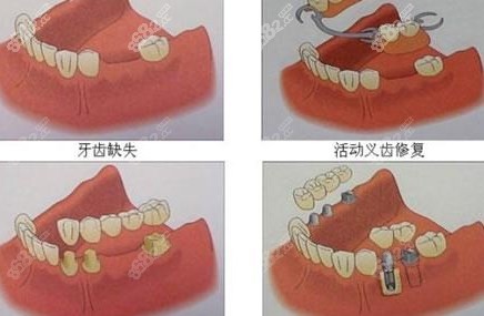 装假牙是固定的好还是活动的好？