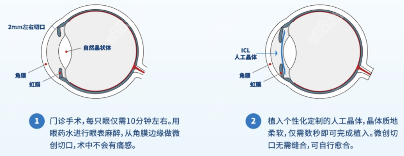 眼睛近视做icl晶体植入过不了军检