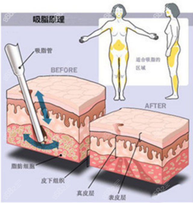 吸脂手术