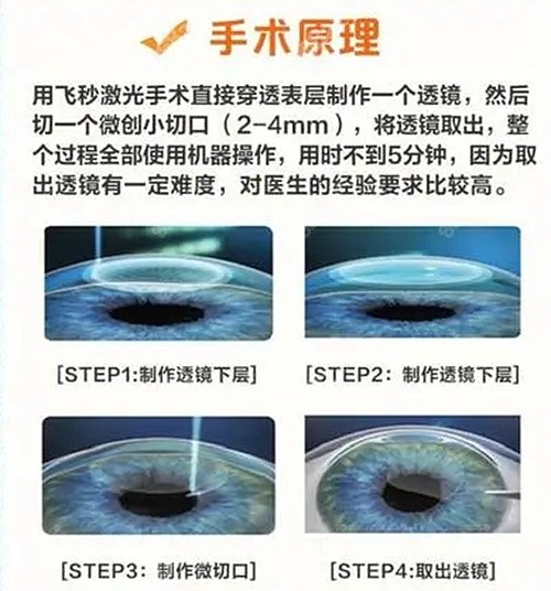 全飞秒手术医院近视手术过程8682.cc