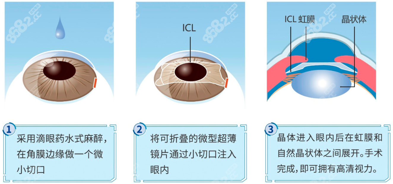 icl官网认证医院医生技术好8682.cc