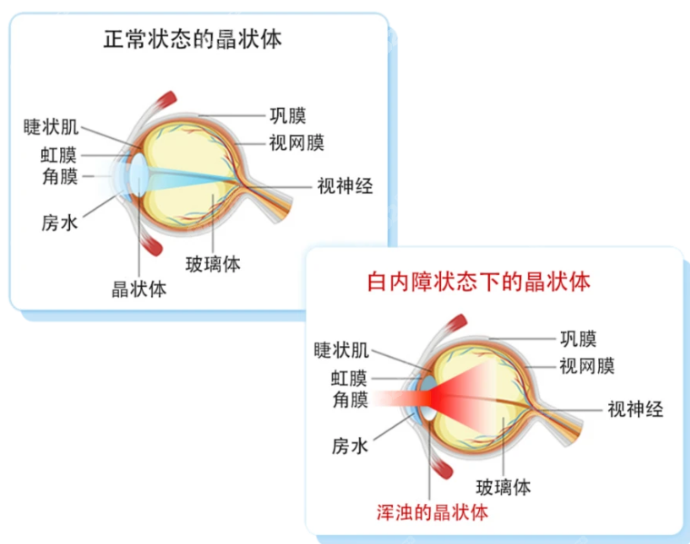 近视晶体和白内障晶体区别大