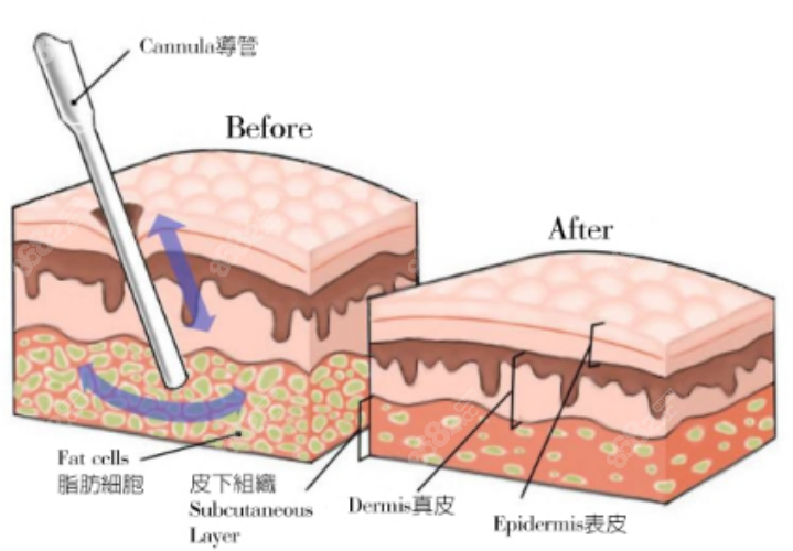 吸脂手术