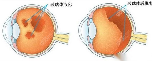飞蚊症