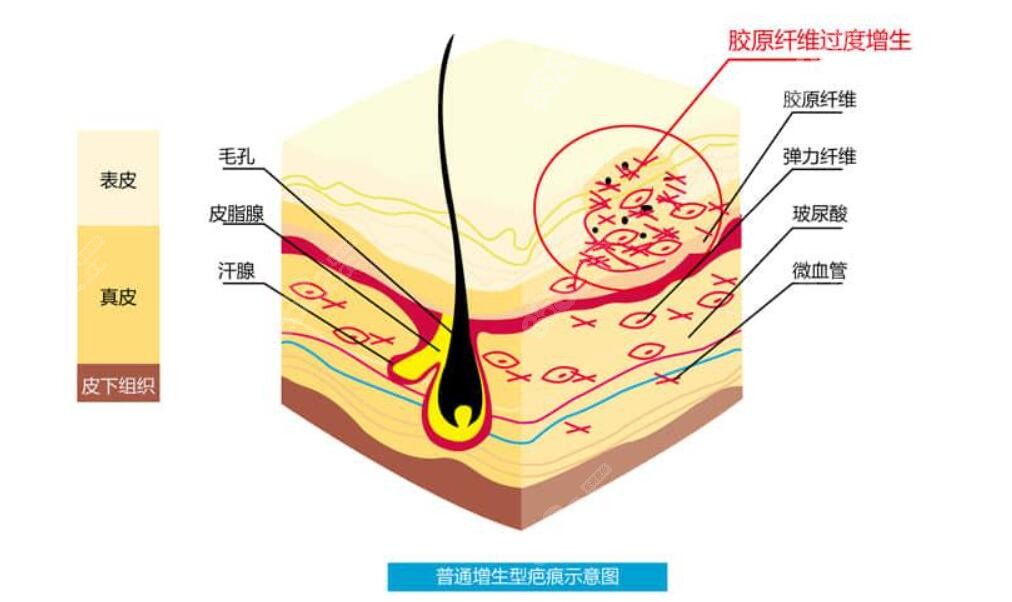 疤痕增生位置示意图