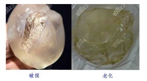胸部假体取出后能马上重新做吗？
