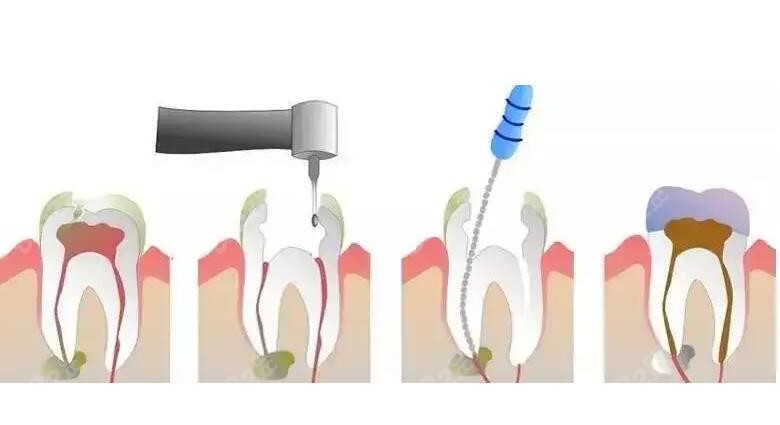 根管治疗