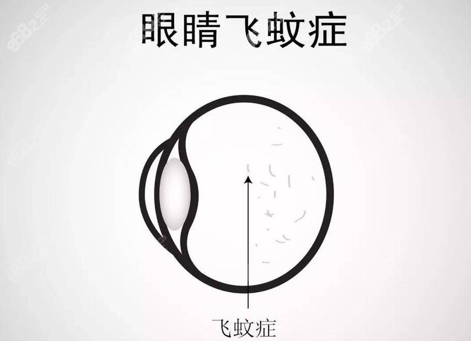 飞蚊症