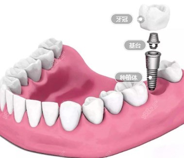 种植牙修复