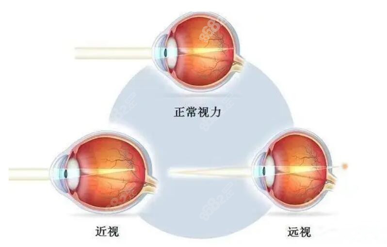 正常视力和远视近视的区别