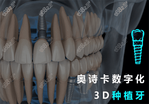  汕头奥诗卡种植牙图