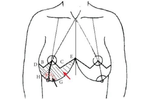 <!--<i data=20240705-sp></i>-->医院整形科巨乳缩小