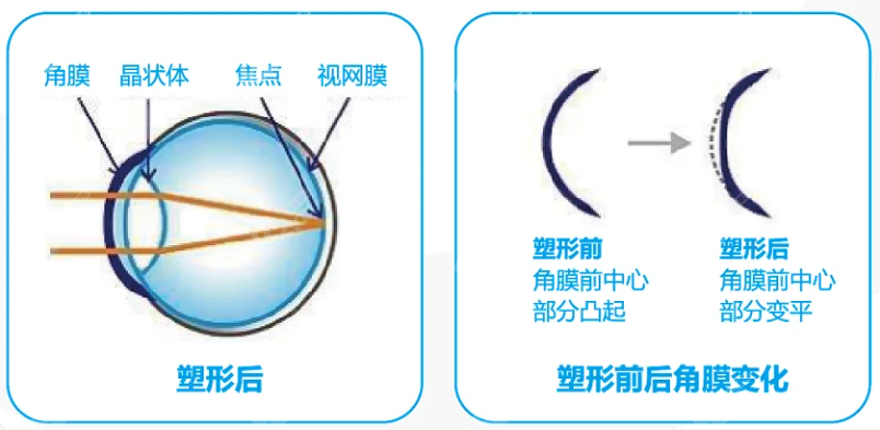 目立康角膜塑形镜价格