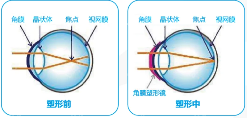 角膜塑形镜至少多少钱8682.cc