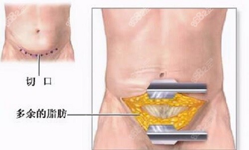 深圳禾正医院整形科腹壁成型术