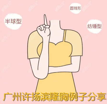 广州许扬滨隆胸例子分享