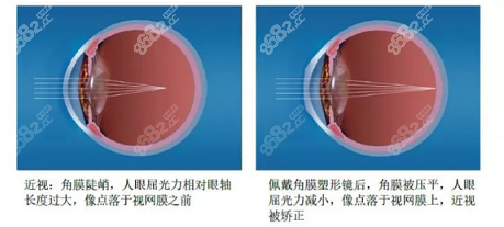 角膜塑形镜的危害已被曝光8682.cc