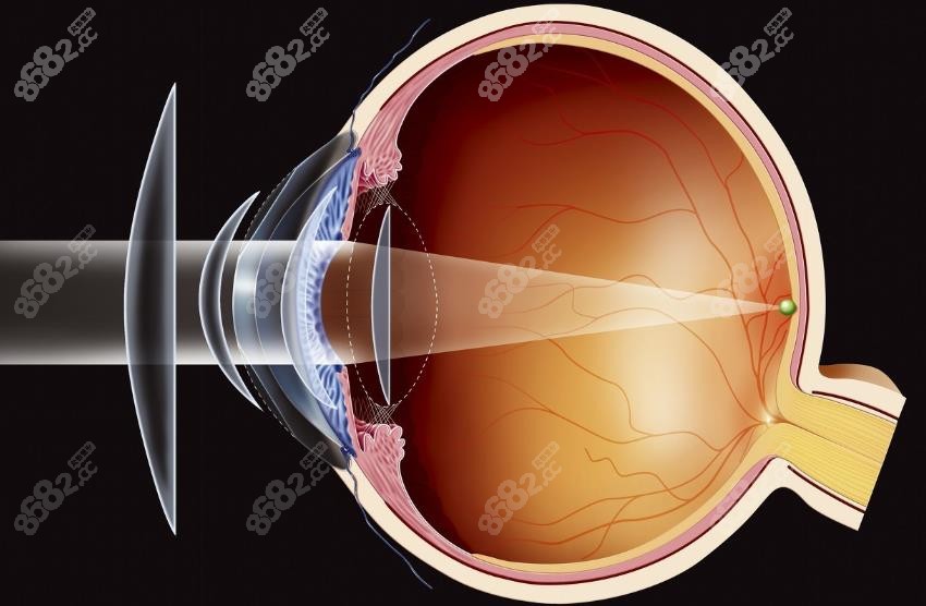 广东深圳佰视佳眼科德国蔡司个性化半飞秒近视手术-www.8682.cc
