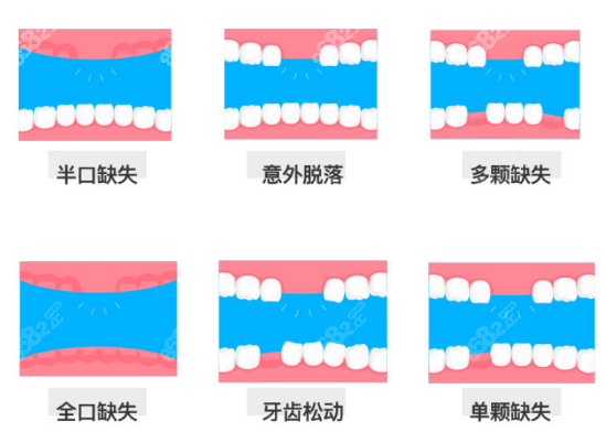 烟台种植牙价格3600元起一颗@8682网