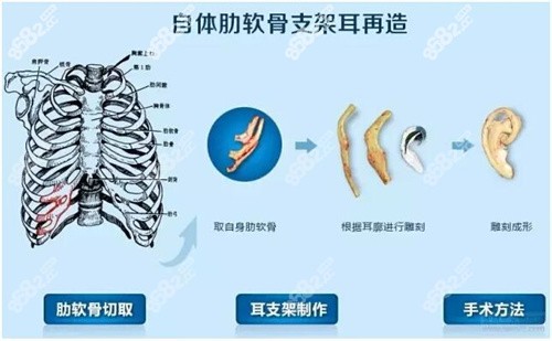 <!--<i data=20240705-sp></i>-->小耳畸形做耳再造价格贵不贵？
