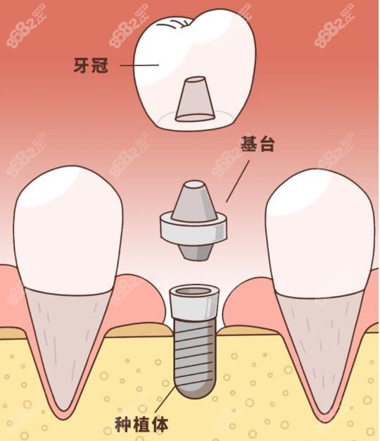 杭州种植牙全套包含