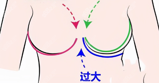 乳房过大示意图
