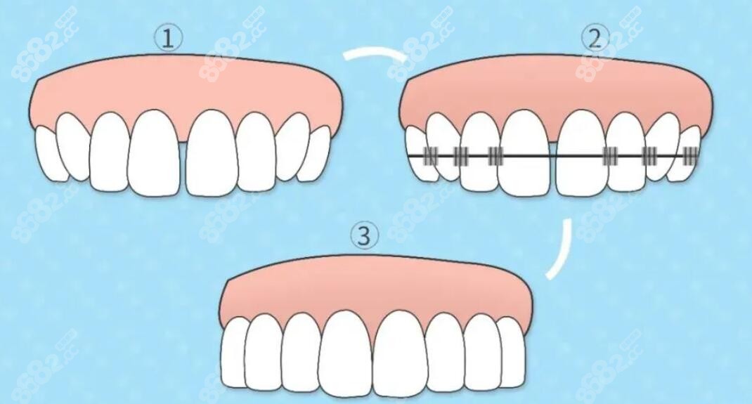 牙齿矫正过程图www.8682.cc