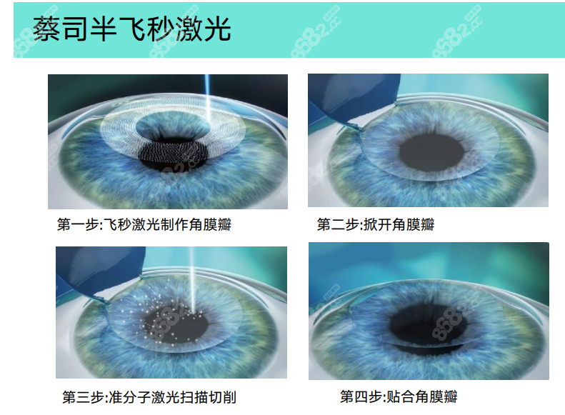 半飞秒手术全过程