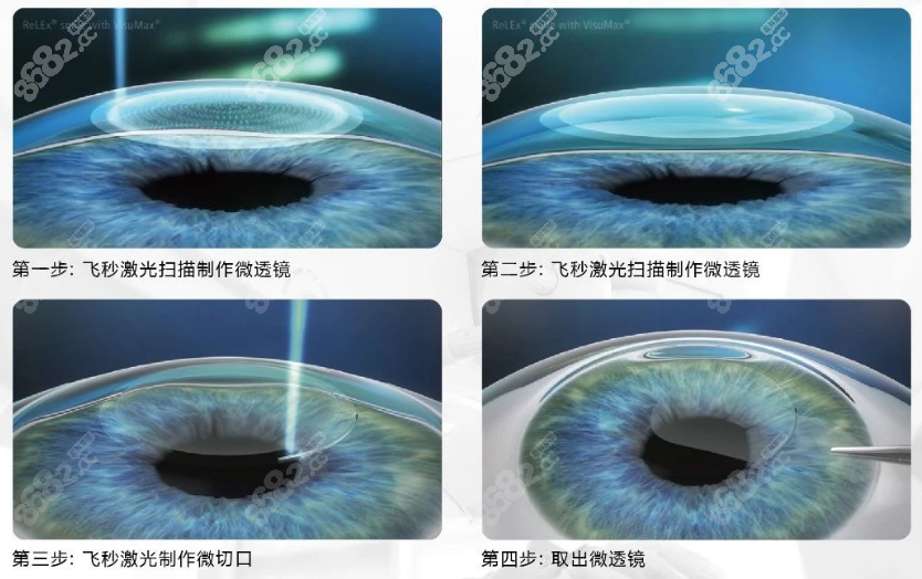 郑州尖峰眼科做全飞秒手术费用