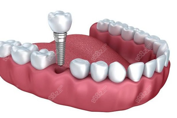 可恩口腔医院种植牙价格m.8682.cc