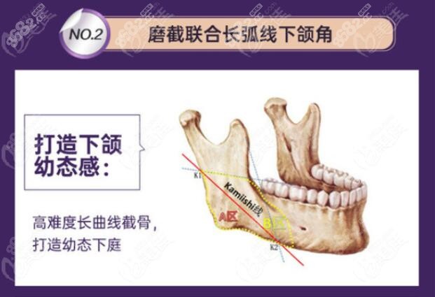 磨截联合下颌角截骨术