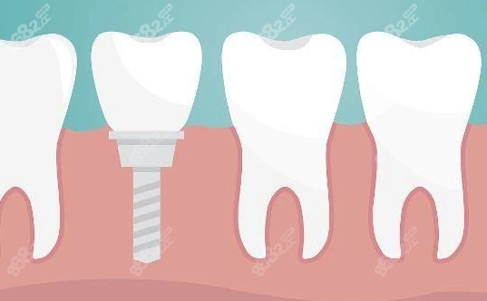 烟台半口种植牙价格31000元起