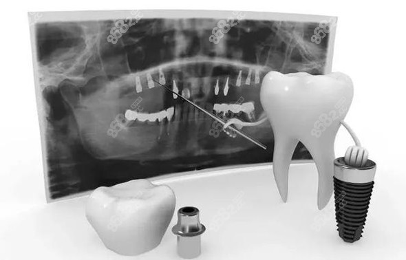 dentium种植牙收费标准