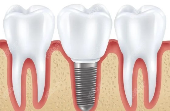 长沙中诺口腔种植牙怎么样