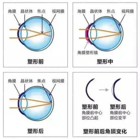 角膜塑形镜(ok镜)的利与弊有哪些m.8682.cc