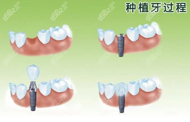 广州种植牙过程