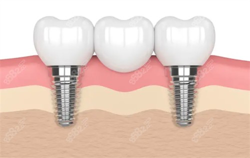 上海鼎植口腔医院种植牙质量怎么样