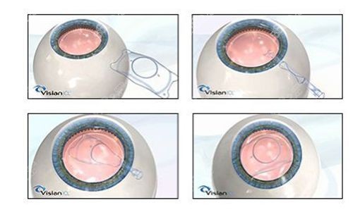 蔡司809m人工晶体价格