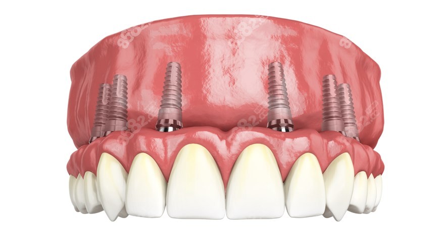 6颗植体的半口种植牙