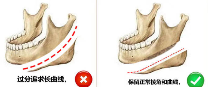 下颌角磨骨