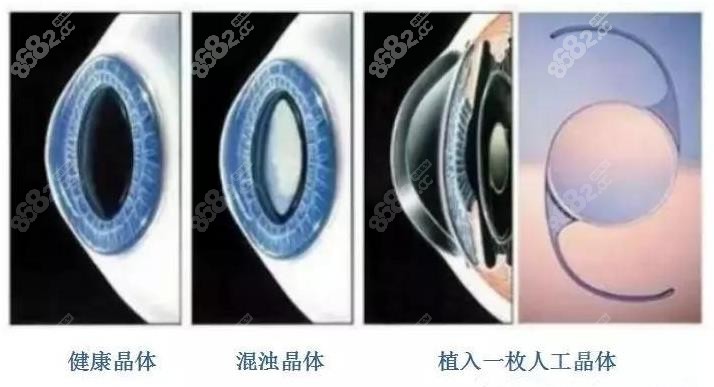 爱尔眼科医院白内障手术费一览表